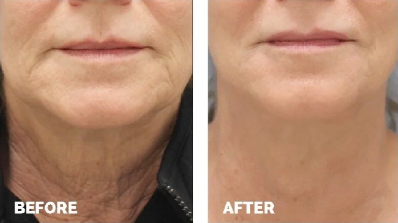 before and after RF microneedling in Landisville