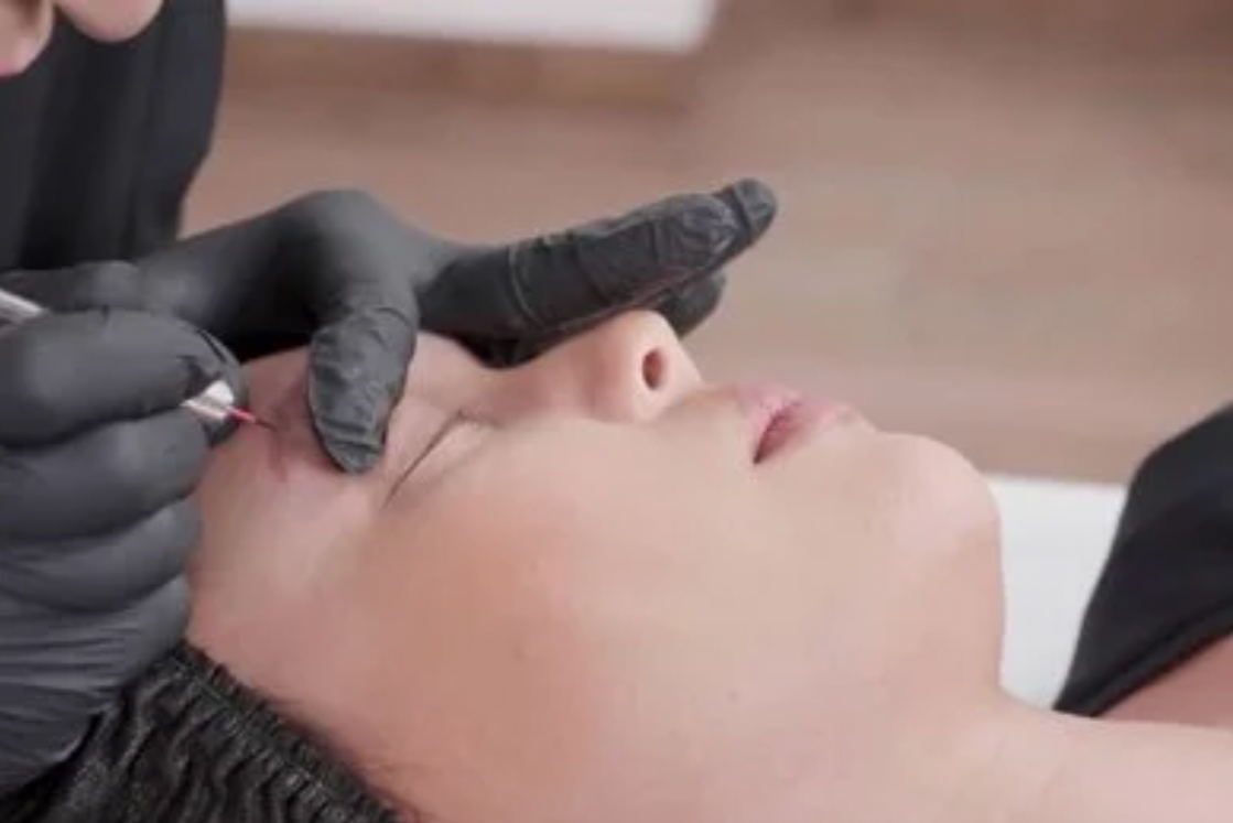 woman getting Li-FT tattoo removal near Lancaster