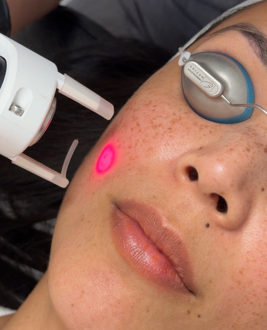 Holiday stress showing up on your skin? ✨

@SkinLaundry laser facials deliver instant brightness and a smoother, clearer complexion &mdash; perfect for getting your glow back during the busy season. 💫
.
.
.
#shopsatlegacyeast #skinlaundry