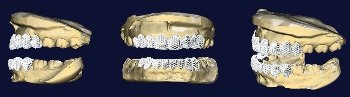 3D digital scans of teeth, showing dental restorations and implants on upper and lower jaws from multiple angles.