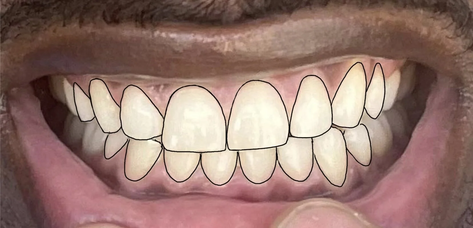 Close-up of a person's open mouth with teeth outlined in black, showing both upper and lower teeth, some overlap, with the lips parted.