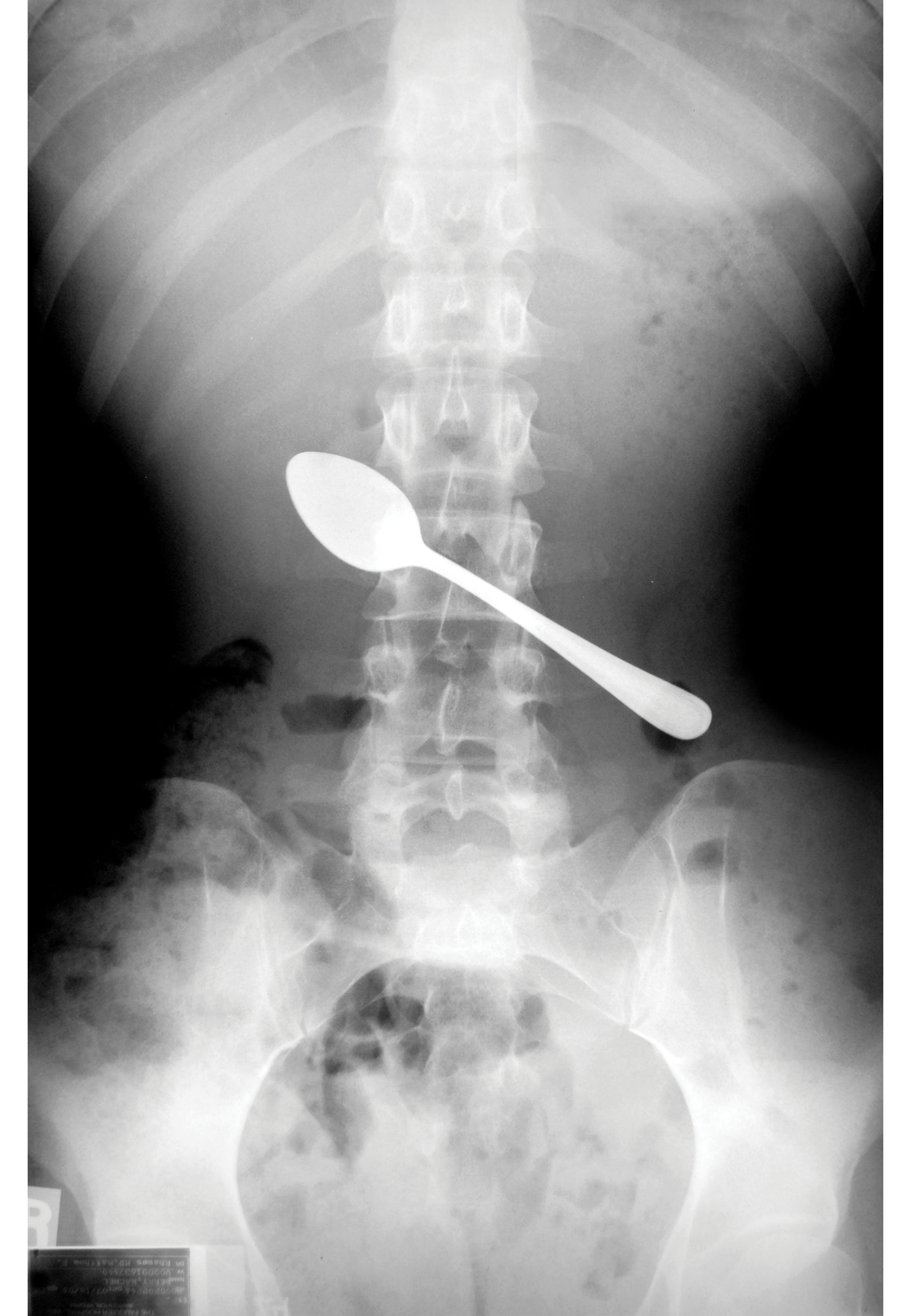 I Swallowed A Spoon