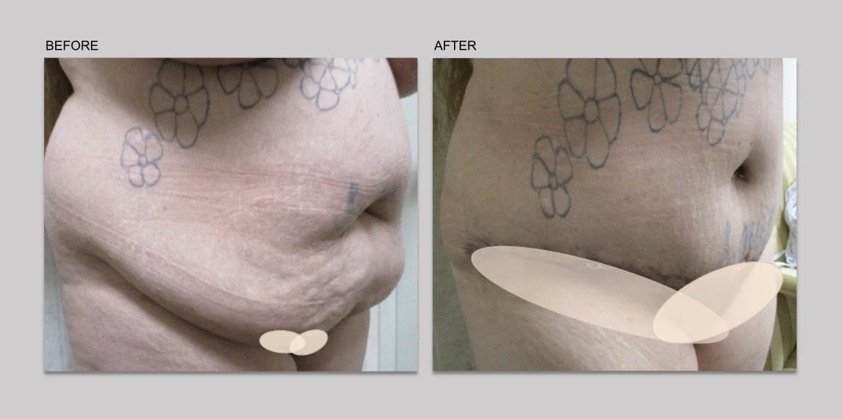 TUMMY TUCK - 3.jpg