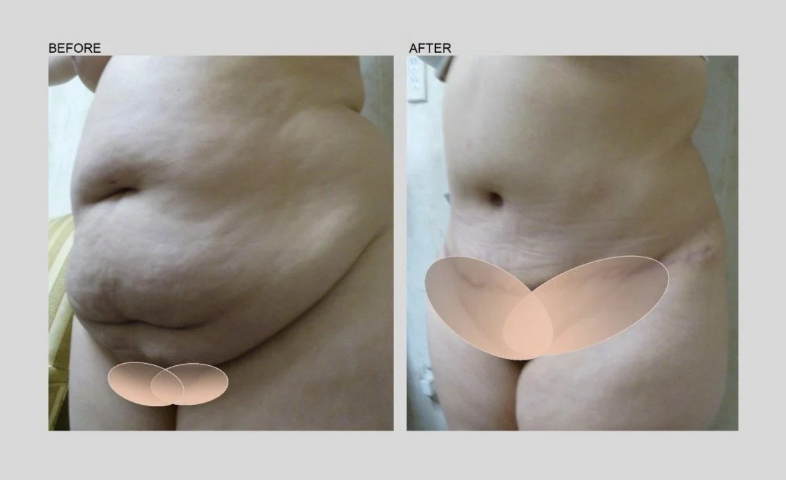 TUMMY TUCK - 5.jpg