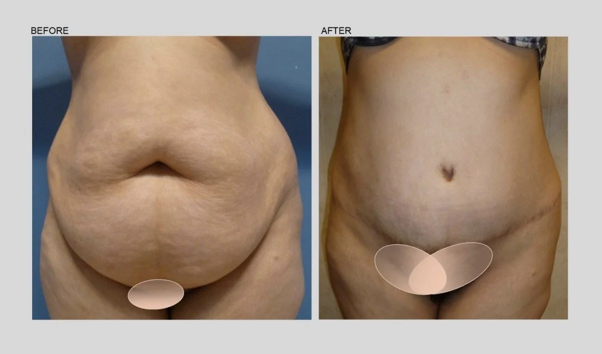 TUMMY TUCK - 2.jpg