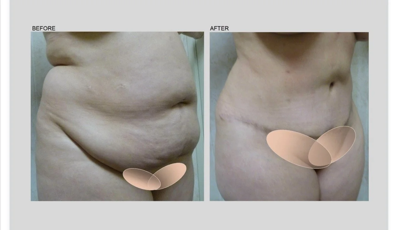TUMMY TUCK -1.jpg