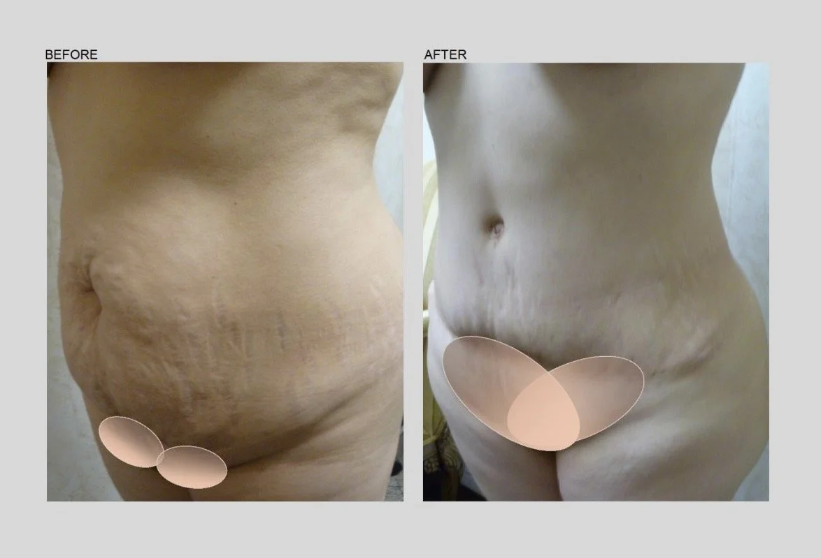 TUMMY TUCK - 4.jpg