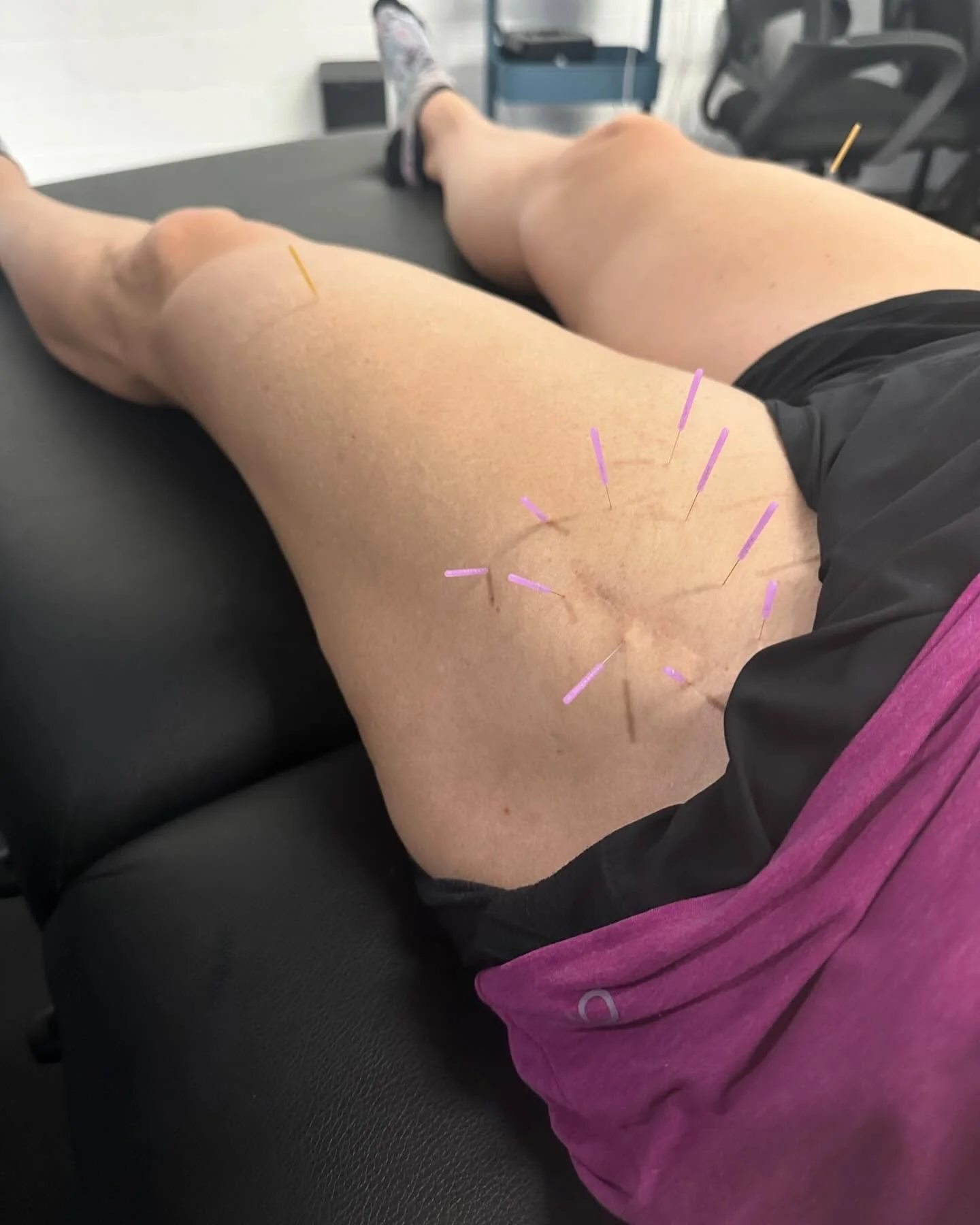 Ever thought about dry needling? 
&bull;
&bull;
Dry needling has so much to offer, locally and globally. 
&bull;
&bull;
Systemically it helps balance out your nervous system. Driving up parasympathetic, rest/relaxation. 
So much of our days are spent