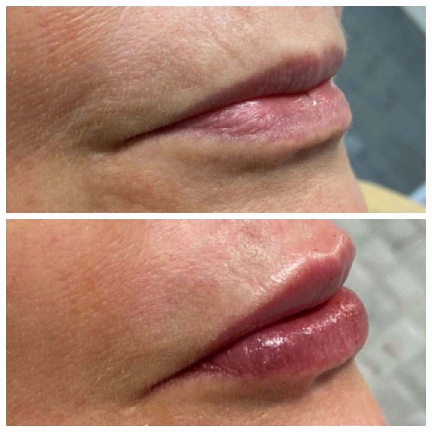 Transform your lips this Valentine's Day!💞 
Aging can make our lips thinner and lose their shape🫦

Consider a conservative dose of Hyaluronic Acid filler for plump, hydrated, and beautifully shaped lips💉💋

Avoid alcohol, especially red wine, befo