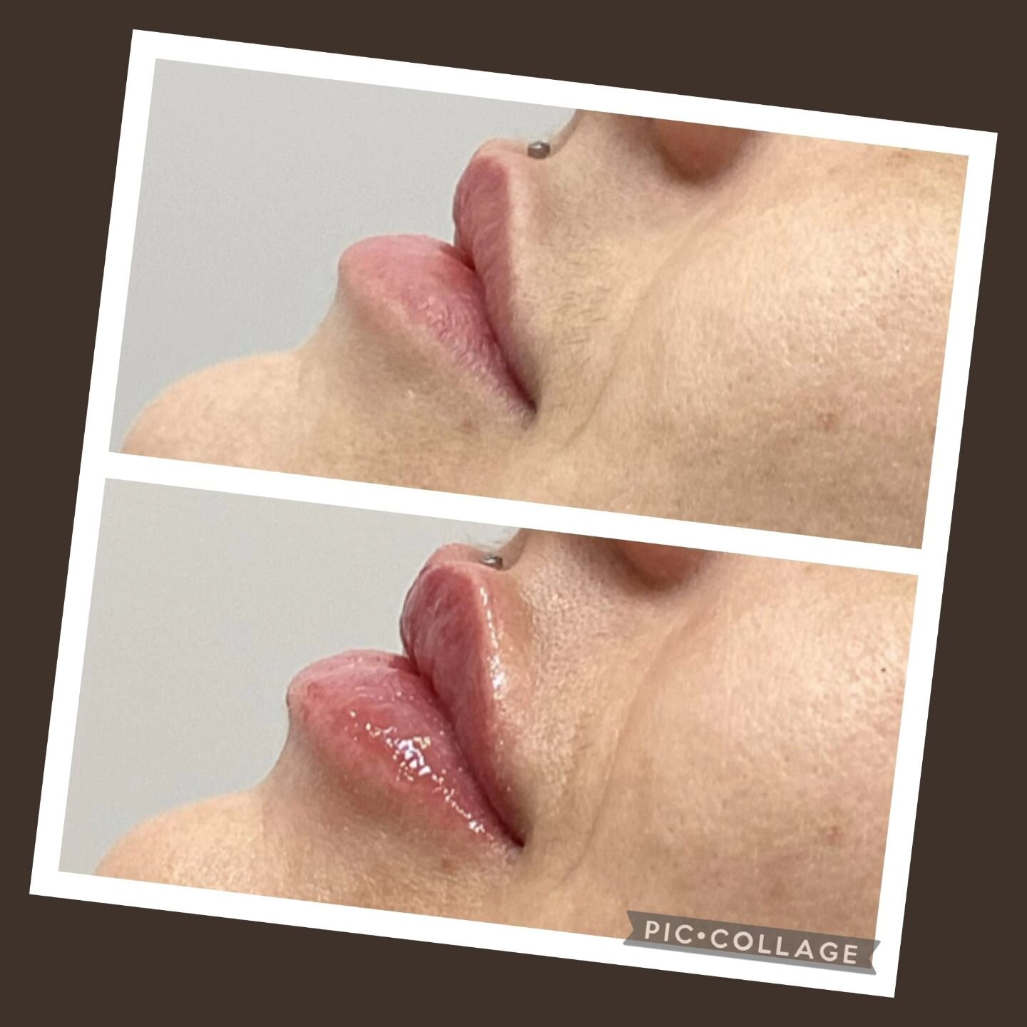 👄 Mini Lip Filler Transformation! 🌟 
Enhancing natural beauty with subtle volume and improved symmetry. Embrace a youthful glow through this minimal intervention. 💖 Discover the benefits of our mini lip filler treatment. 
.
.
.
#NaturalBeauty #Lip