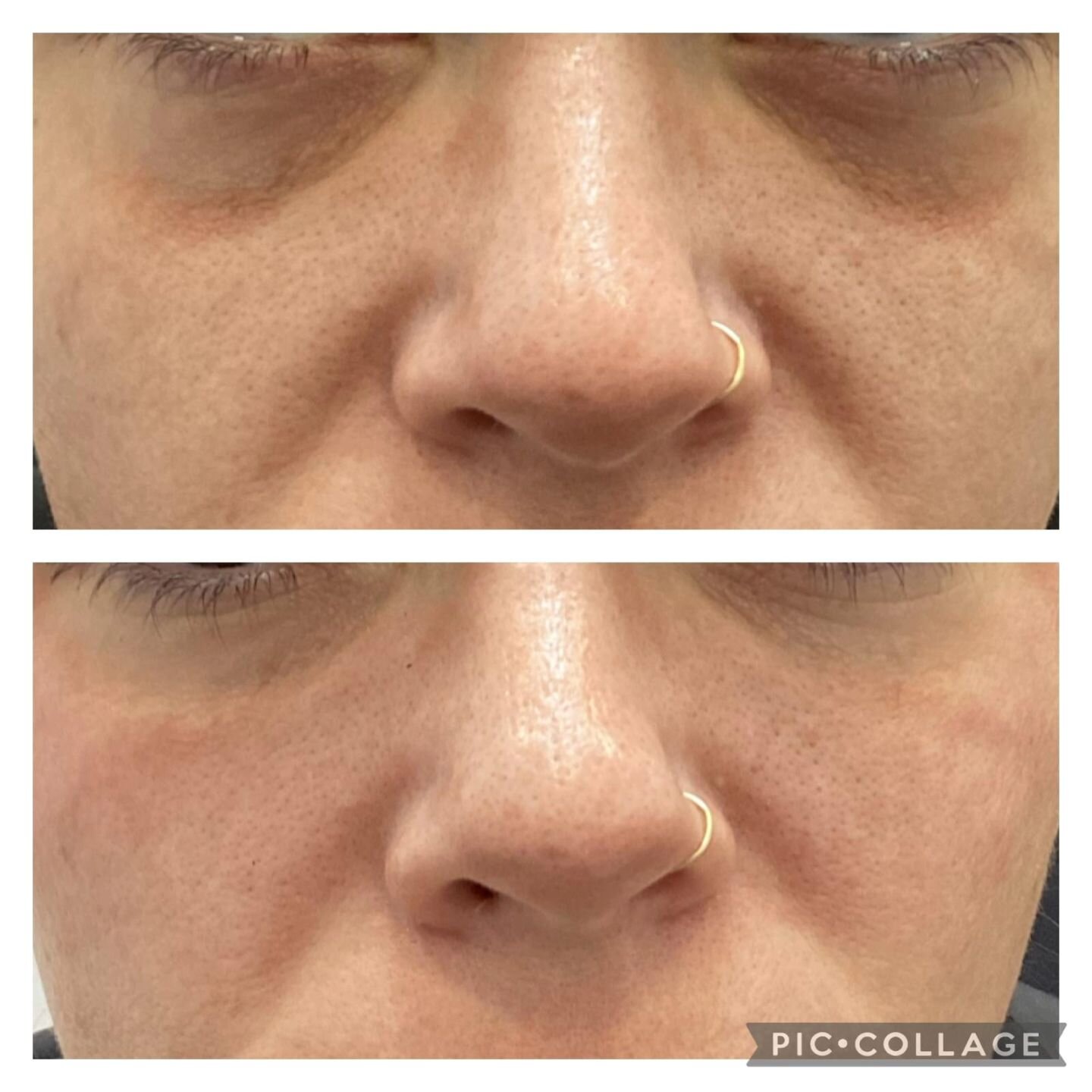 Experience the magic of our skilled nurse injector, Nurse Sara, at Sayaderm Cosmetic Injectables! ✨ 

One syringe of Teosyal Redensity 2 transformed these under eyes, leaving our client delighted. 
Say goodbye to dark circles and hello to a refreshed