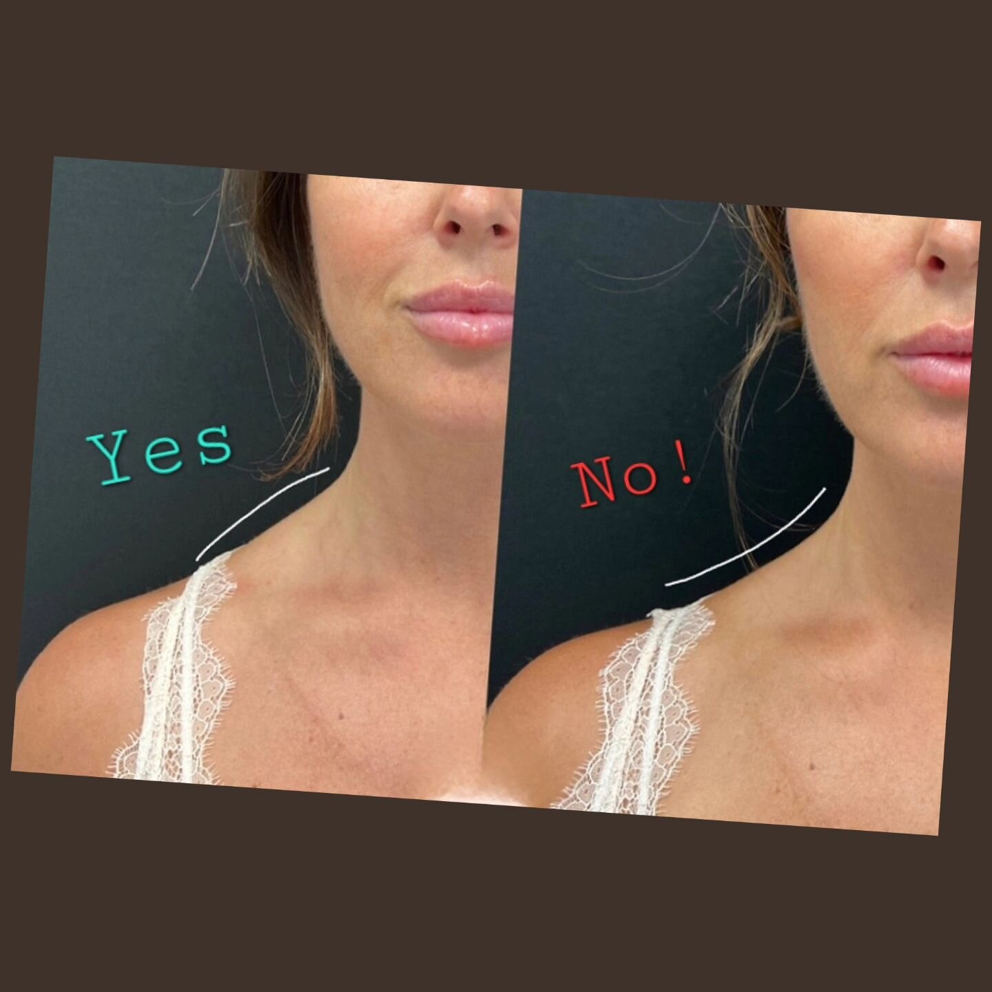 In recent times, a concerning trend has emerged on platforms like TikTok and Instagram, dubbed &quot;Brabie Botox.&quot; This practice involves regular Botox injections into the trapezius muscles (shoulders) with the aim of achieving a slimmer and mo