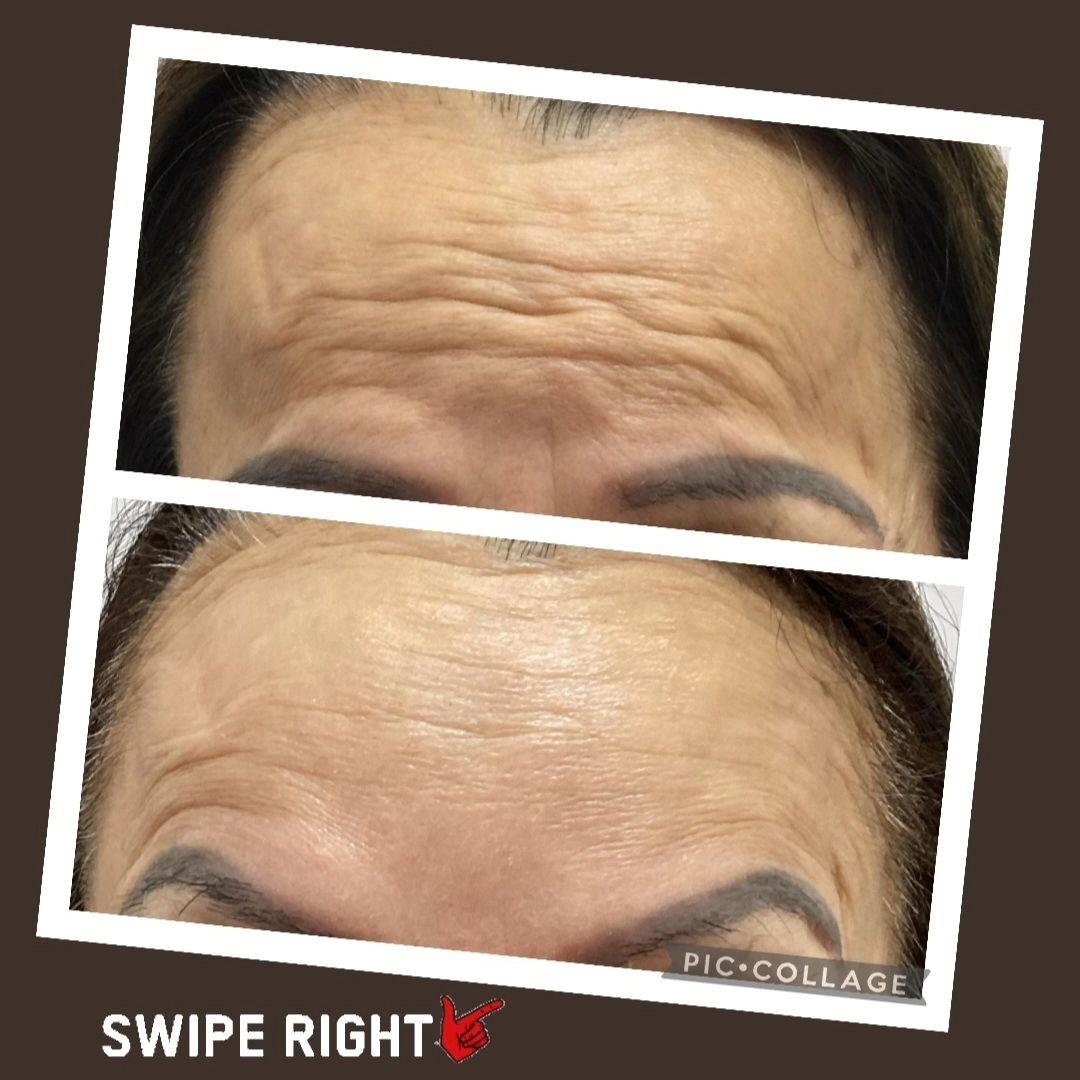 🌟 Before &amp; after transformation! Swipe to see the gradual change ✨
 
Did you know Botox works its magic slowly? It takes about two weeks to see the full results. For first-timers, I always start with a conservative dosage to ensure the perfect l