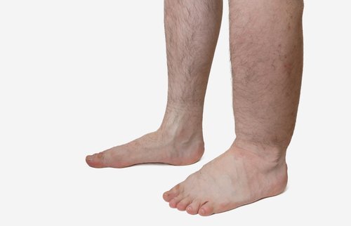 Why do you get leg swelling?