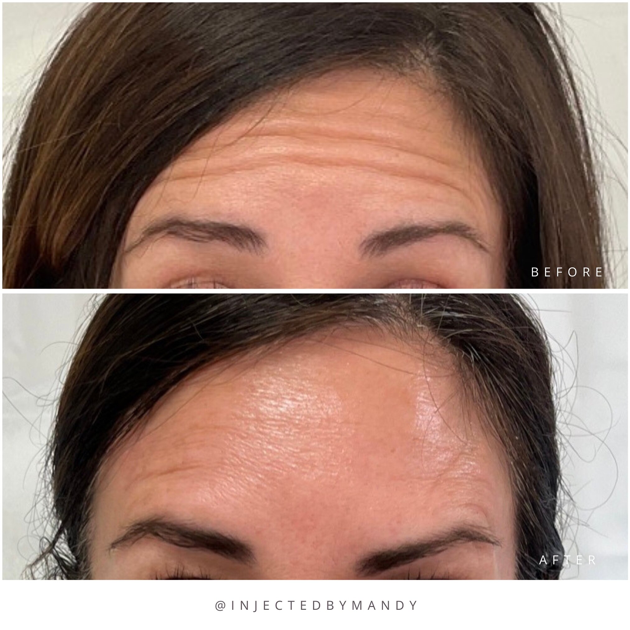 2 week follow ups are just as important as your first appointment! 

During our consult, my sweet client said that she often gets a heavy brow from past Botox appointments. Knowing this, I adjusted her injection points knowing she would probably get 