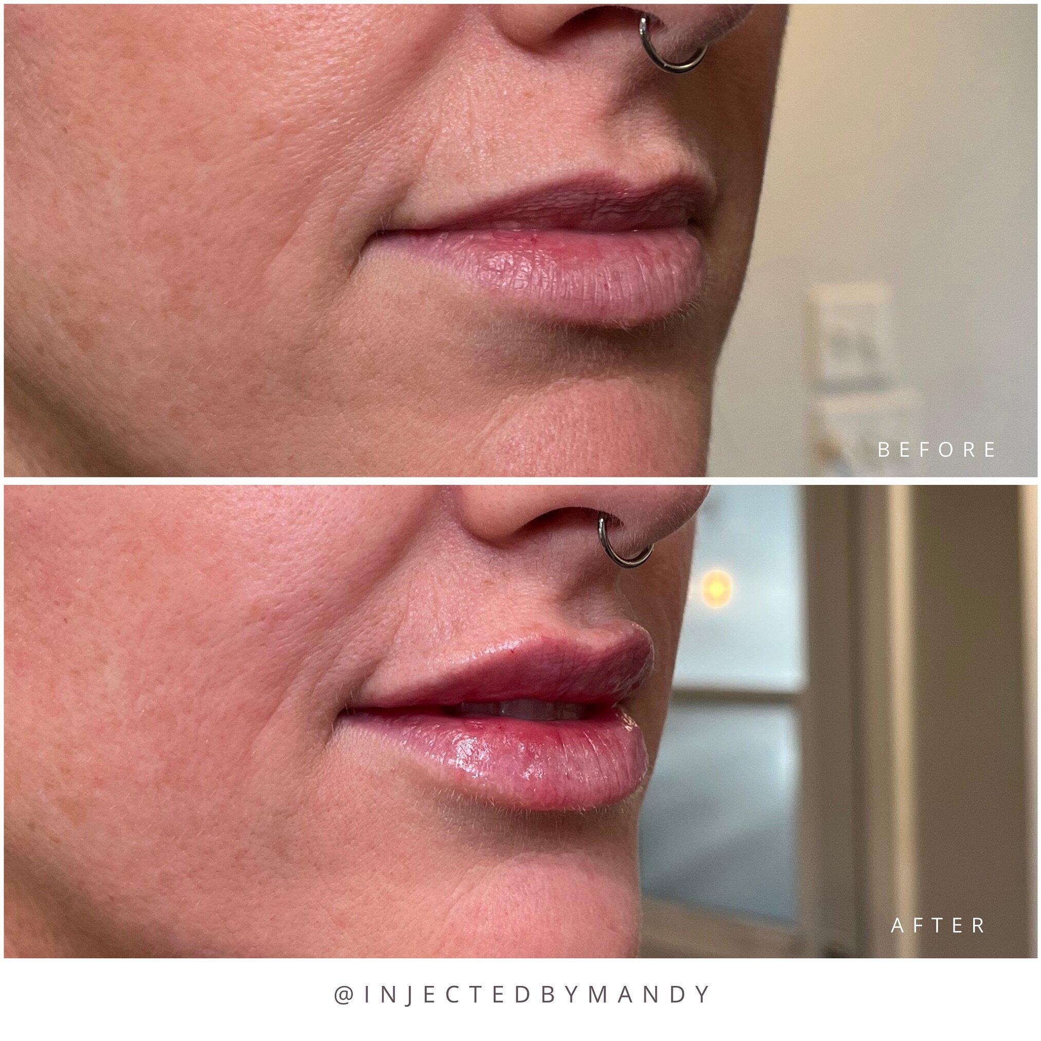 A little touch up for this beauty 🤩 

Can you believe this beauty had very thin lips that disappeared when she smiled? If this is you, be patient with results because they&rsquo;ll take time. 

Multiple appointments to inject small amounts of filler