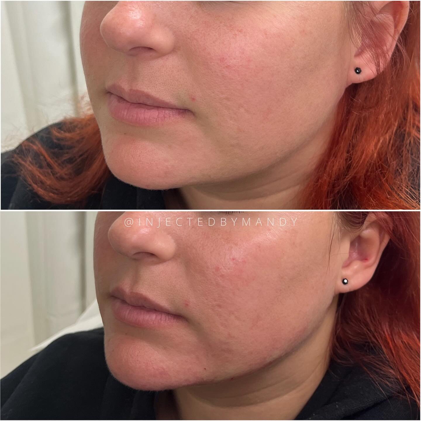 Did you know I can enhance your jawline with filler?

It sounds counterintuitive to add filler or volume  to an area you want to appear more chiseled, but when placed correctly it can make a difference. 

For jawline, plan on 2-4 syringes and multipl