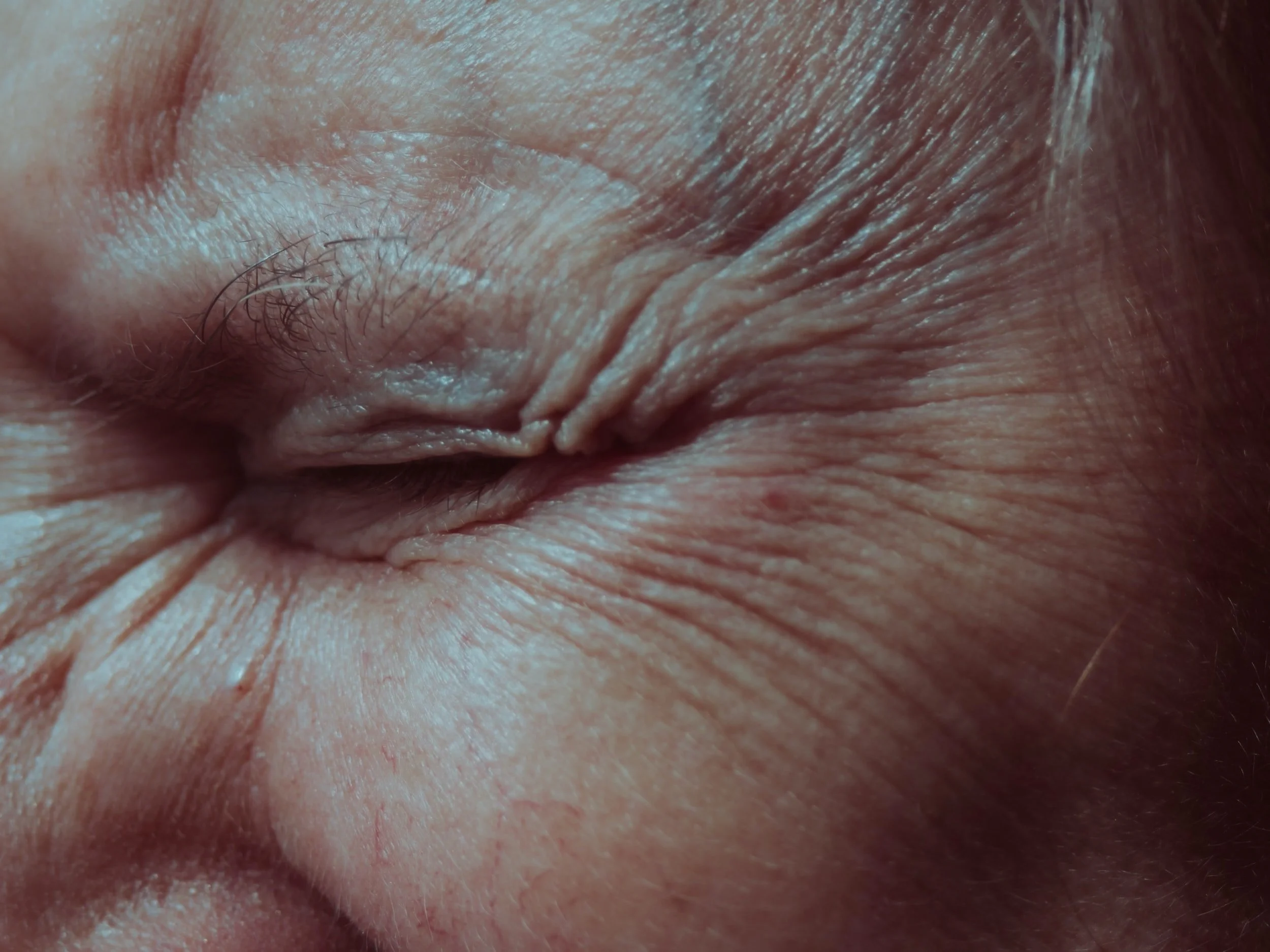 Botox para arrugas Dermatologa Estetica Barcelona Dra Monika Heisig