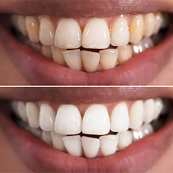 Pure White Advanced before and after results