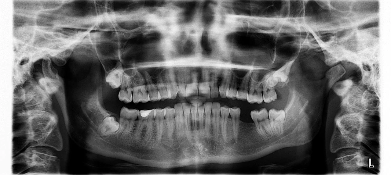 Experts Announce Human Trials for Teeth Regrowth Drug