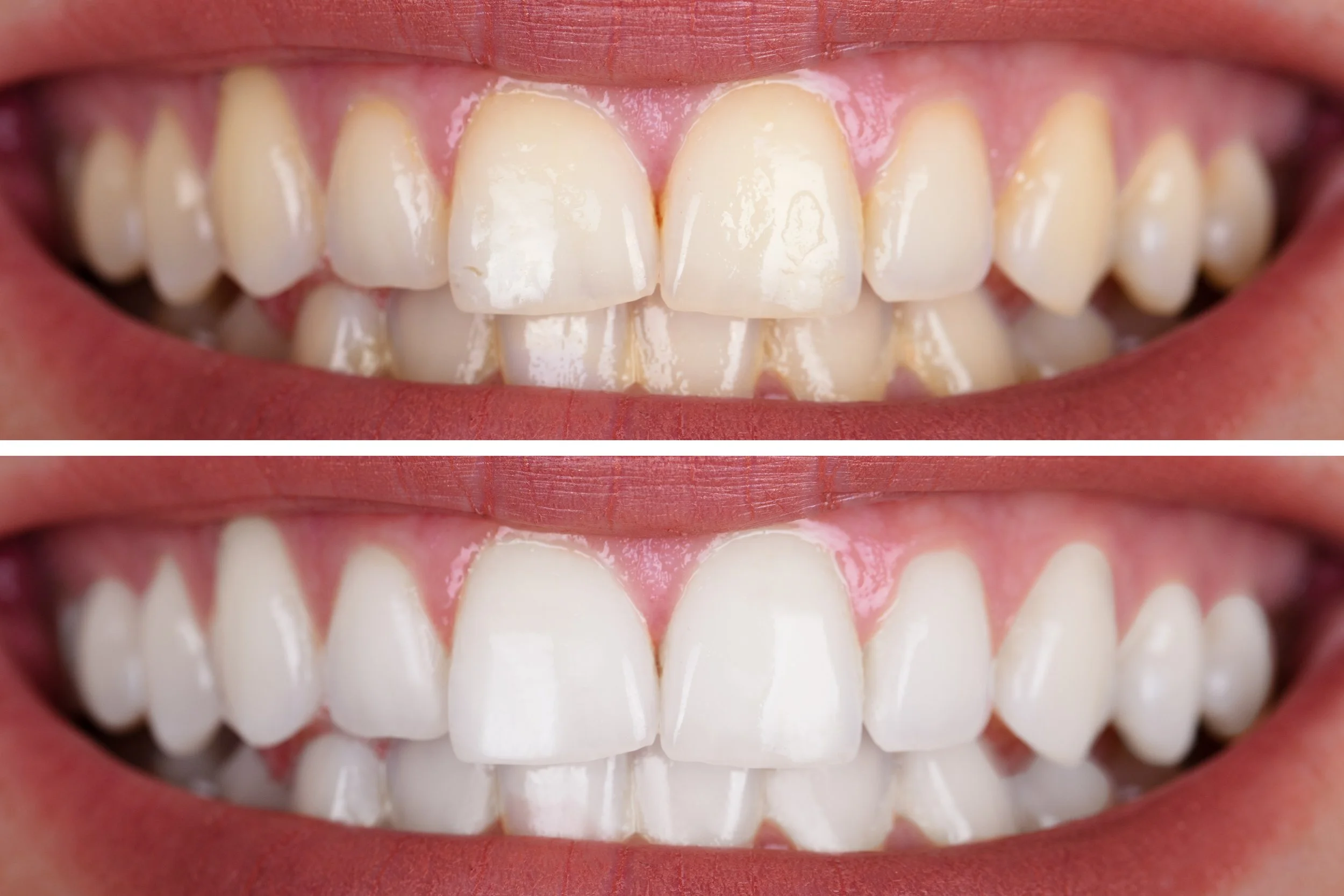 Before-and-after teeth-whitening comparison showing significant color improvement.