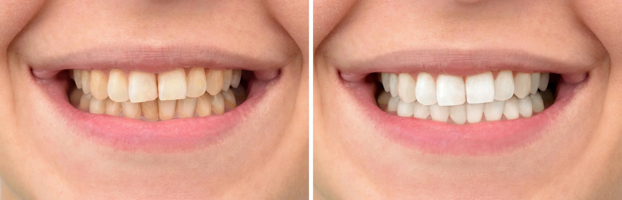 Before-and-after teeth-whitening comparison showing significant color improvement.