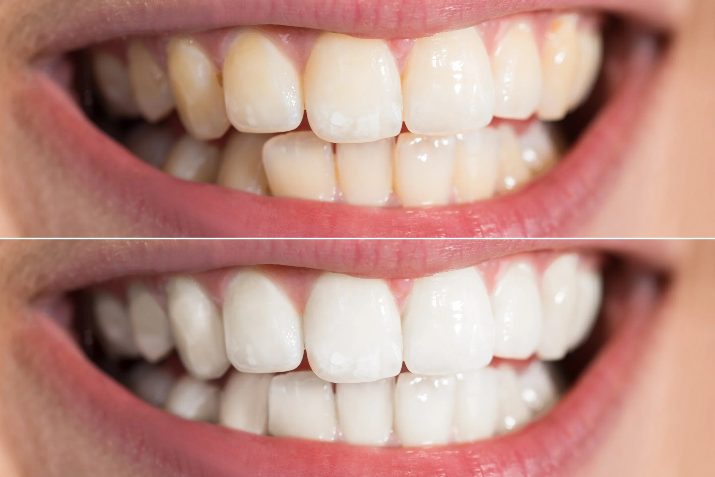 Before-and-after teeth-whitening comparison showing significant color improvement.