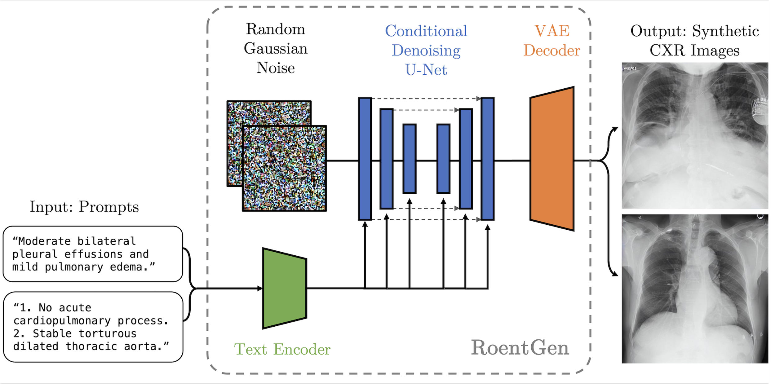 Fine-tuning Stable Diffusion for Chest X-ray Generation
