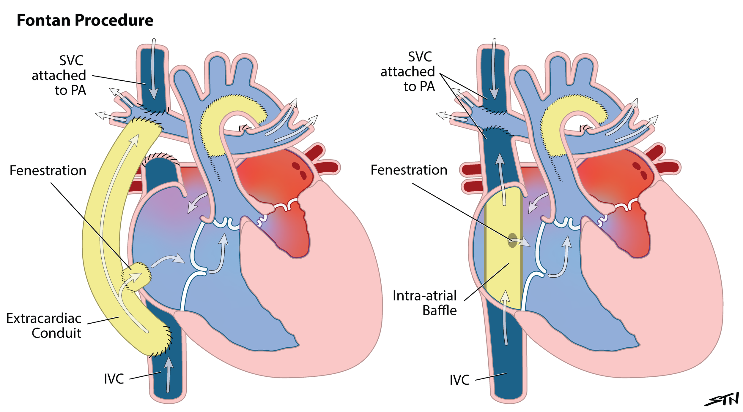 Fontan Procedure