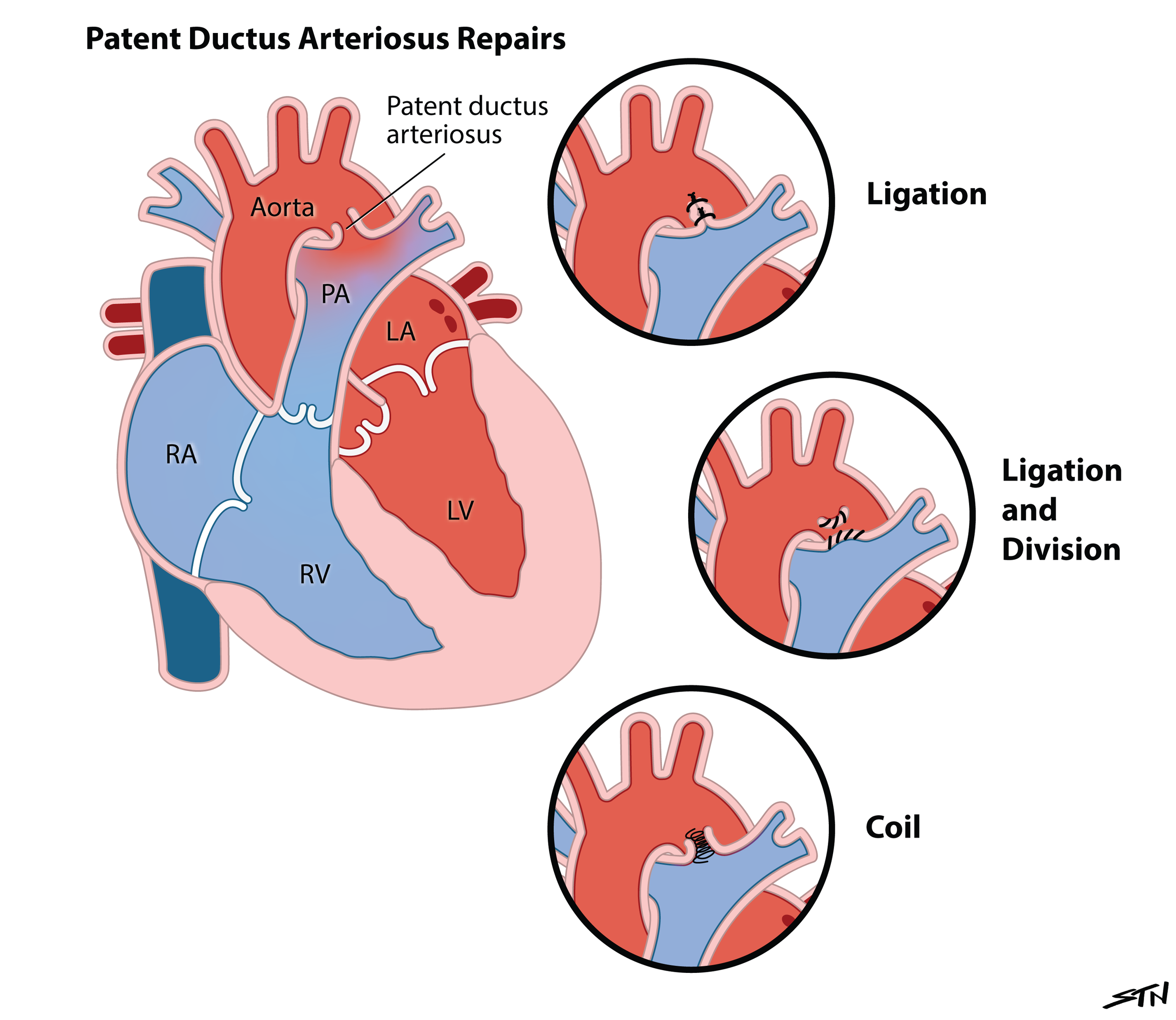 Patent Ductus