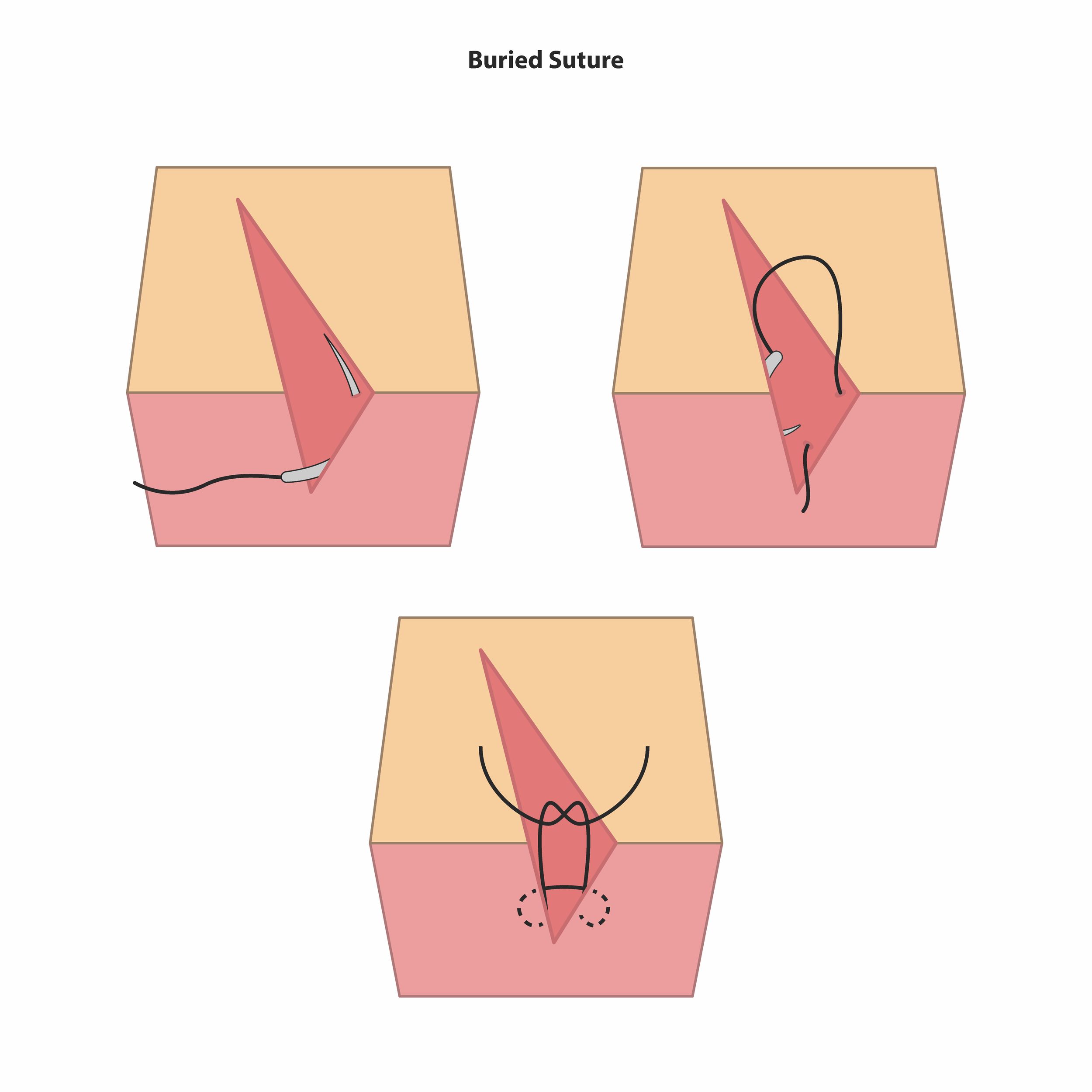 Buried Suture
