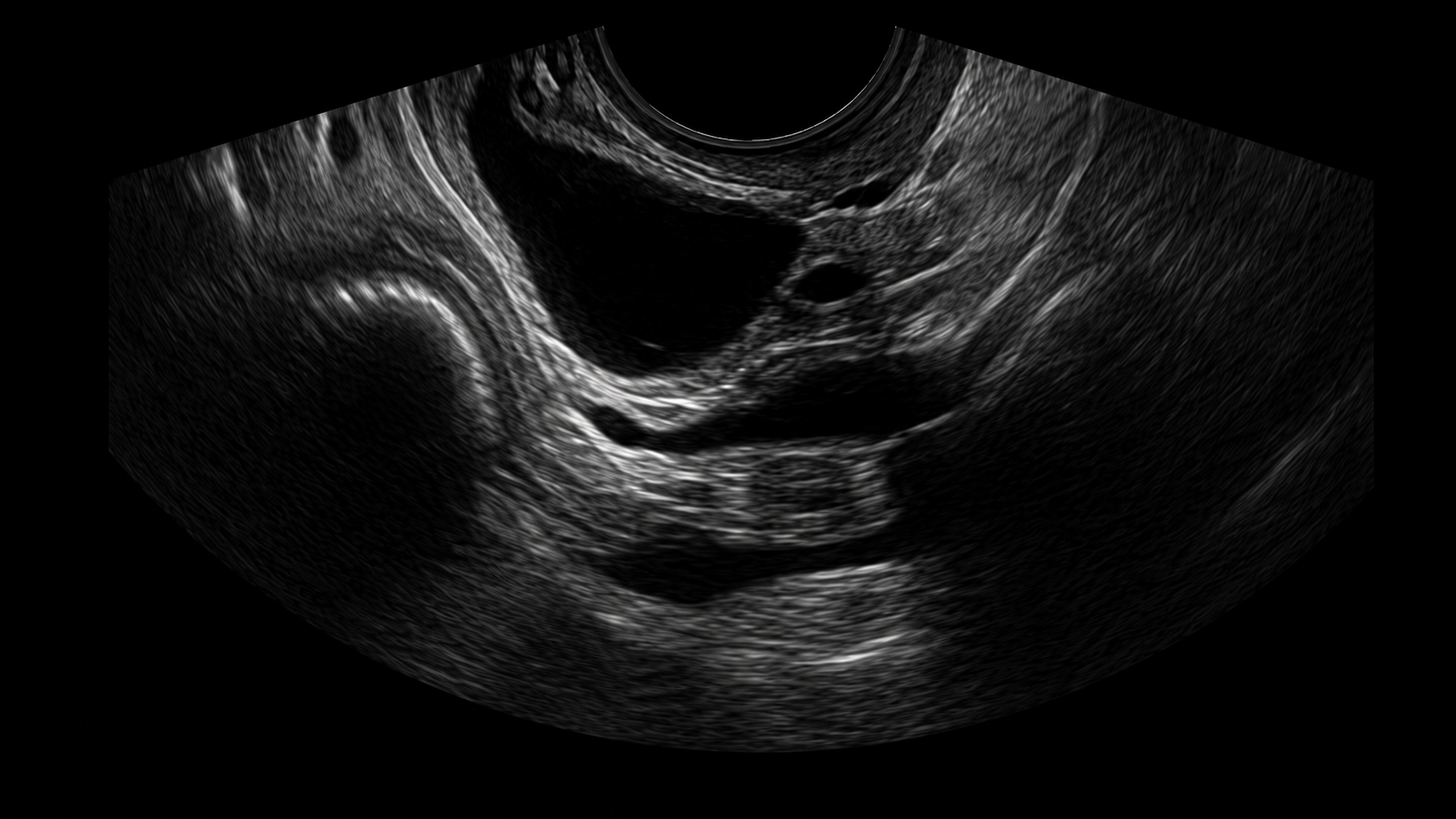 Ultrasound image showing a black circular area surrounded by gray and white tissue structures, likely an internal organ or follicle.
