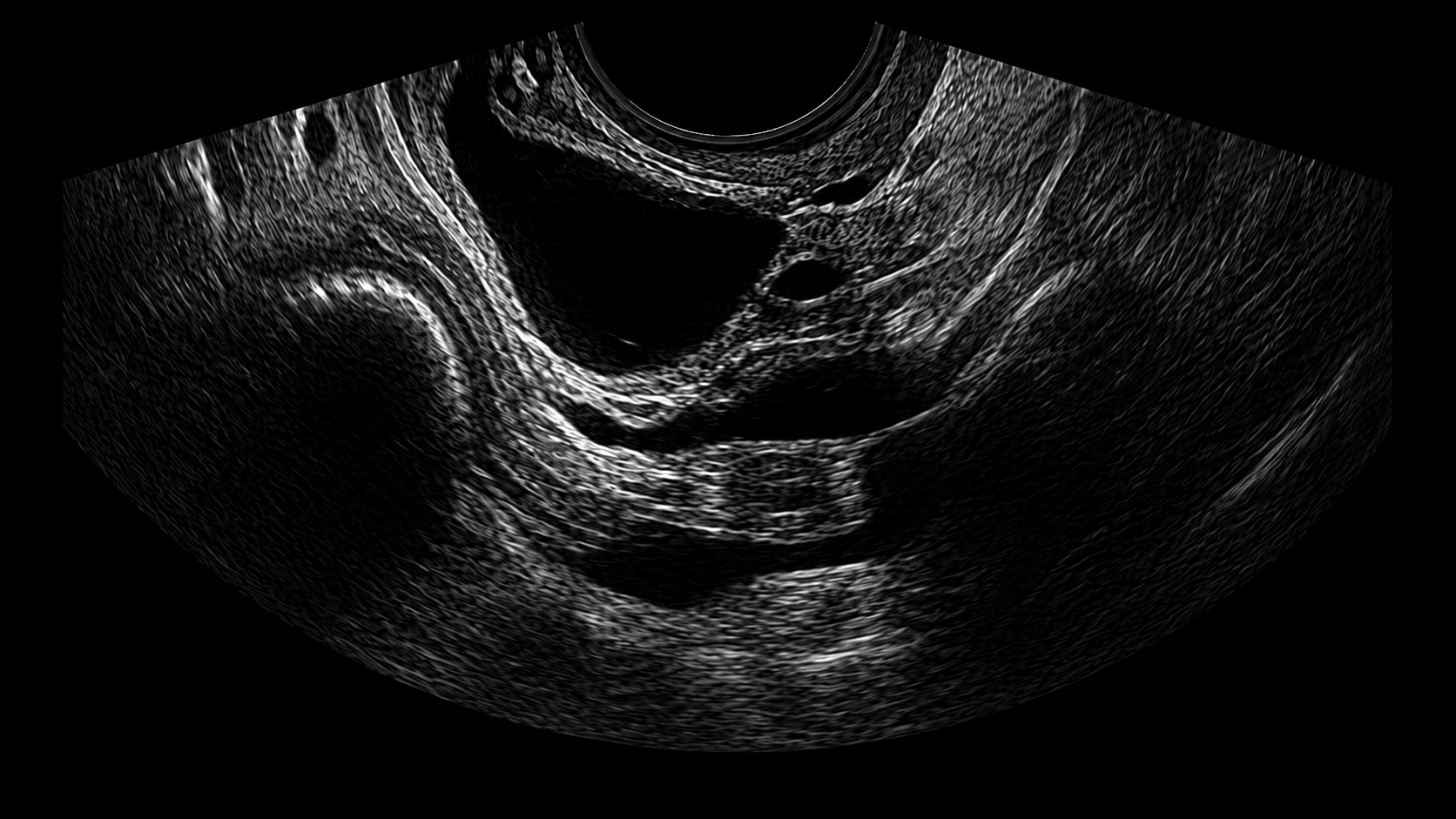 Ultrasound image of a female pelvis showing ovaries and uterus.