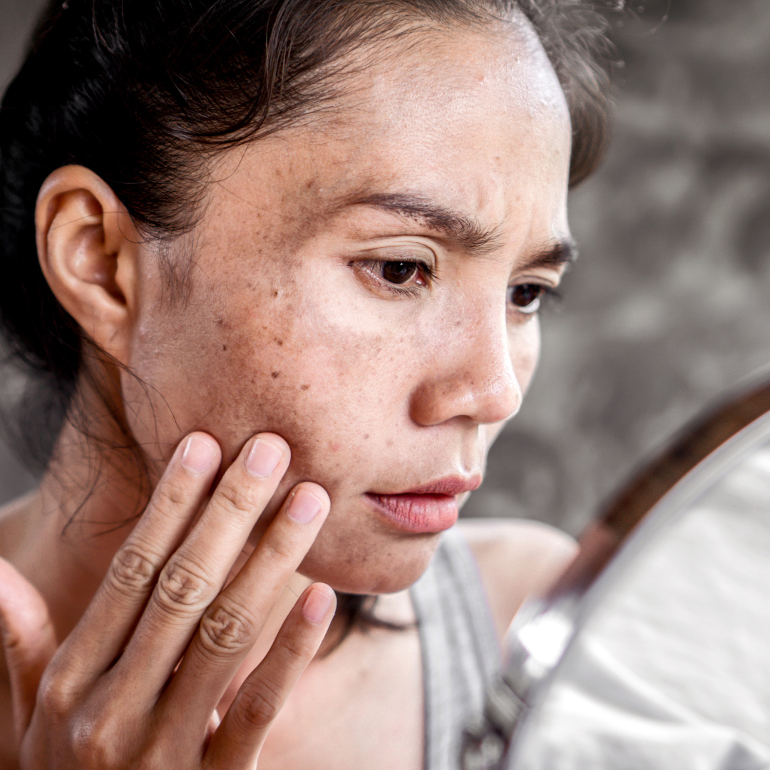 KRX Peel &amp; Hyperpigmentation: What It Fixes (And What It Doesn’t)