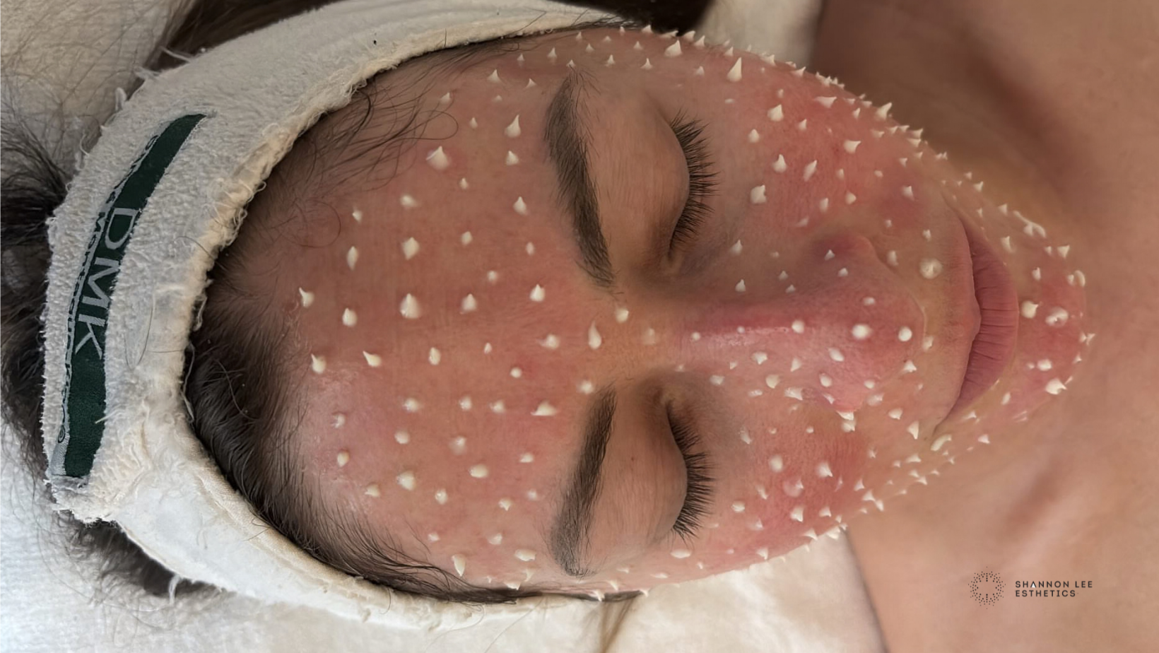 Loved Microneedling? Here’s What We’re Doing Now (And Why It Works)