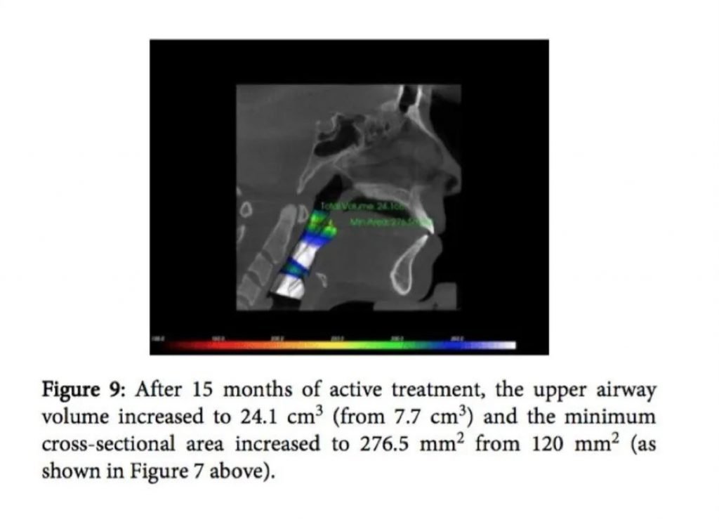 Fix Overbite & Increase Airway Volume in Huntington, NY