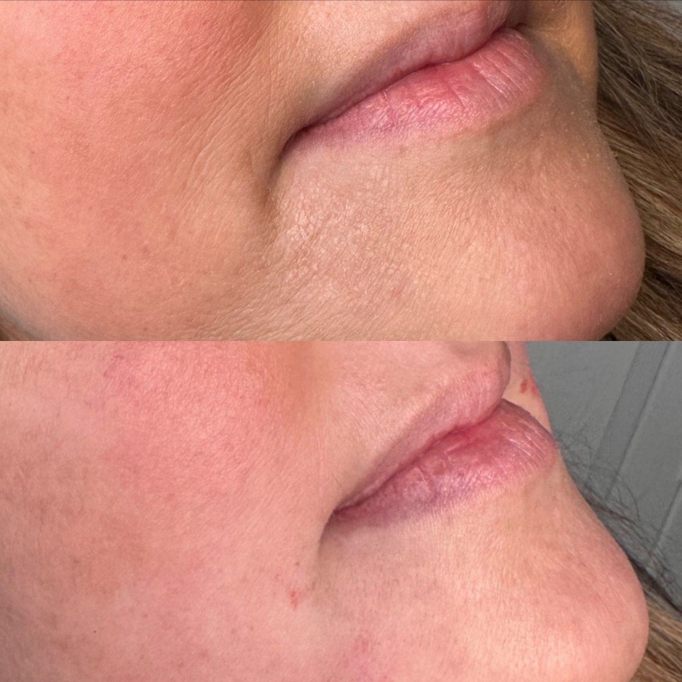 Dermal Fillers