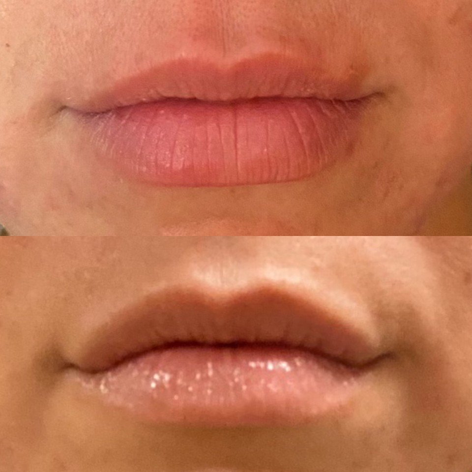 Lip Filler