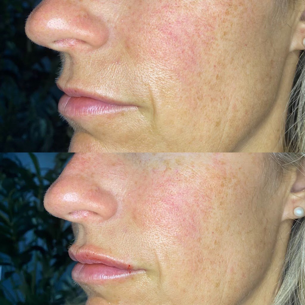 Lip Filler