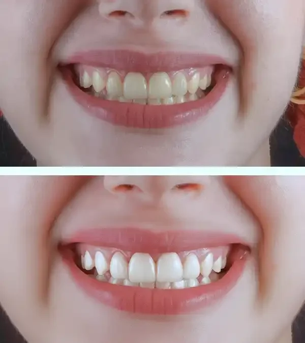Professional Teeth Whitening in Atherton