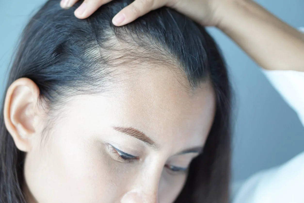Woman experiencing hair loss on scalp