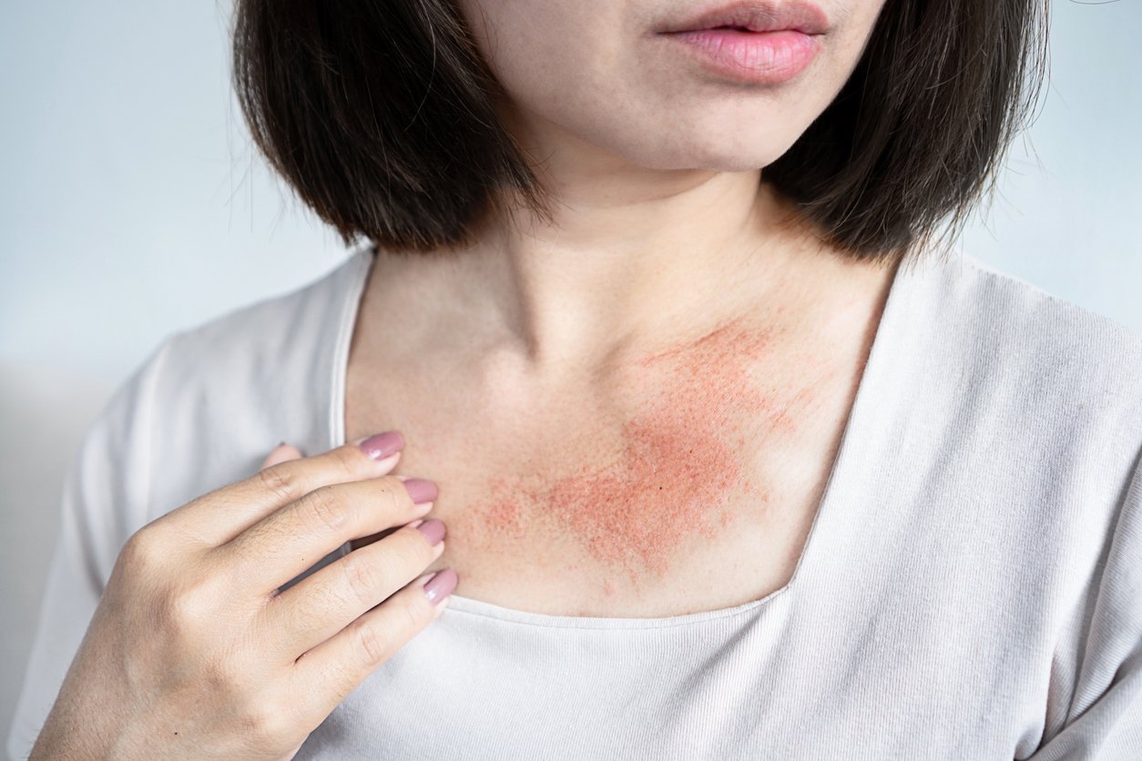 Woman with a rash and red, irritated skin on her neck