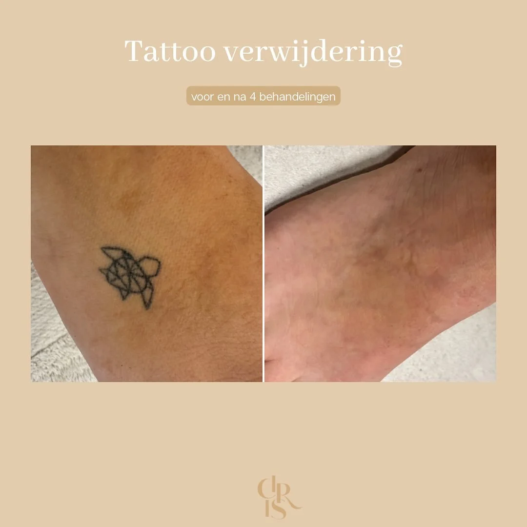 𝐓𝐚𝐭𝐭𝐨𝐨 𝐯𝐞𝐫𝐰𝐢𝐣𝐝𝐞𝐫𝐢𝐧𝐠 ✨

Spijt van je tattoo? 
Geen probleem! Bij ons kan je terecht voor een removal zonder littekens of pigmentverlies met onze picolaser. 

4 sessies voor &amp; na 🤩

📲 www.cirisbeauty.be
📞 0471132328
📍 Doelstra