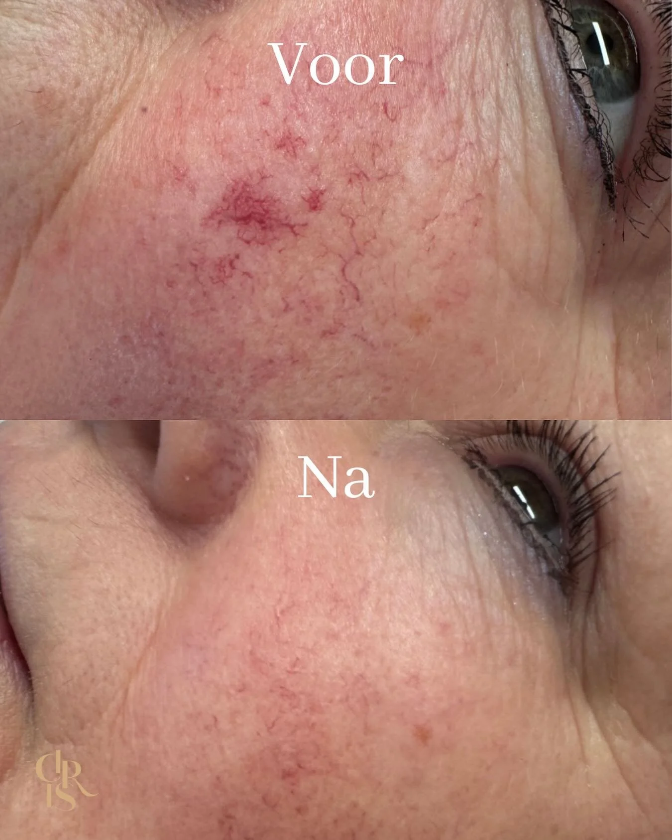 &ldquo;𝐂𝐨𝐮𝐩𝐞𝐫𝐨𝐬𝐞 𝐯𝐞𝐫𝐰𝐢𝐣𝐝𝐞𝐫𝐞𝐧&rdquo;

Heb jij last van adertjes of couperose op de huid? 🤔
Met de Clarity II behandelen we couperose effectief en met zichtbaar resultaat. 
Dit is na 1 behandeling met de laser! 

September-oktober 