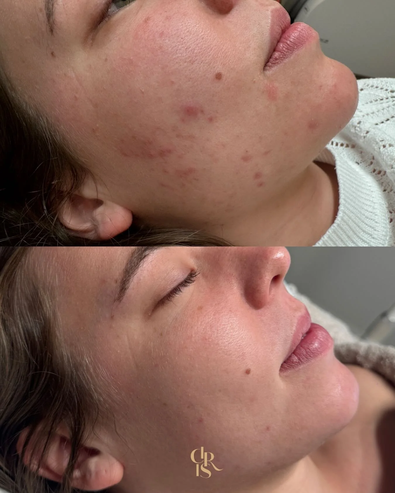 &ldquo;𝑨𝒄𝒏𝒆 𝒃𝒆𝒉𝒂𝒏𝒅𝒆𝒍𝒊𝒏𝒈&rdquo;

Bye bye acne, hello glow! 🤩✨

Een krachtige combinatie van laser, peeling en LED-therapie voor een zuivere, gladde huid. 

Wil jij ook komaf maken met ontstekingen en littekens? Boek jouw acne behandeli