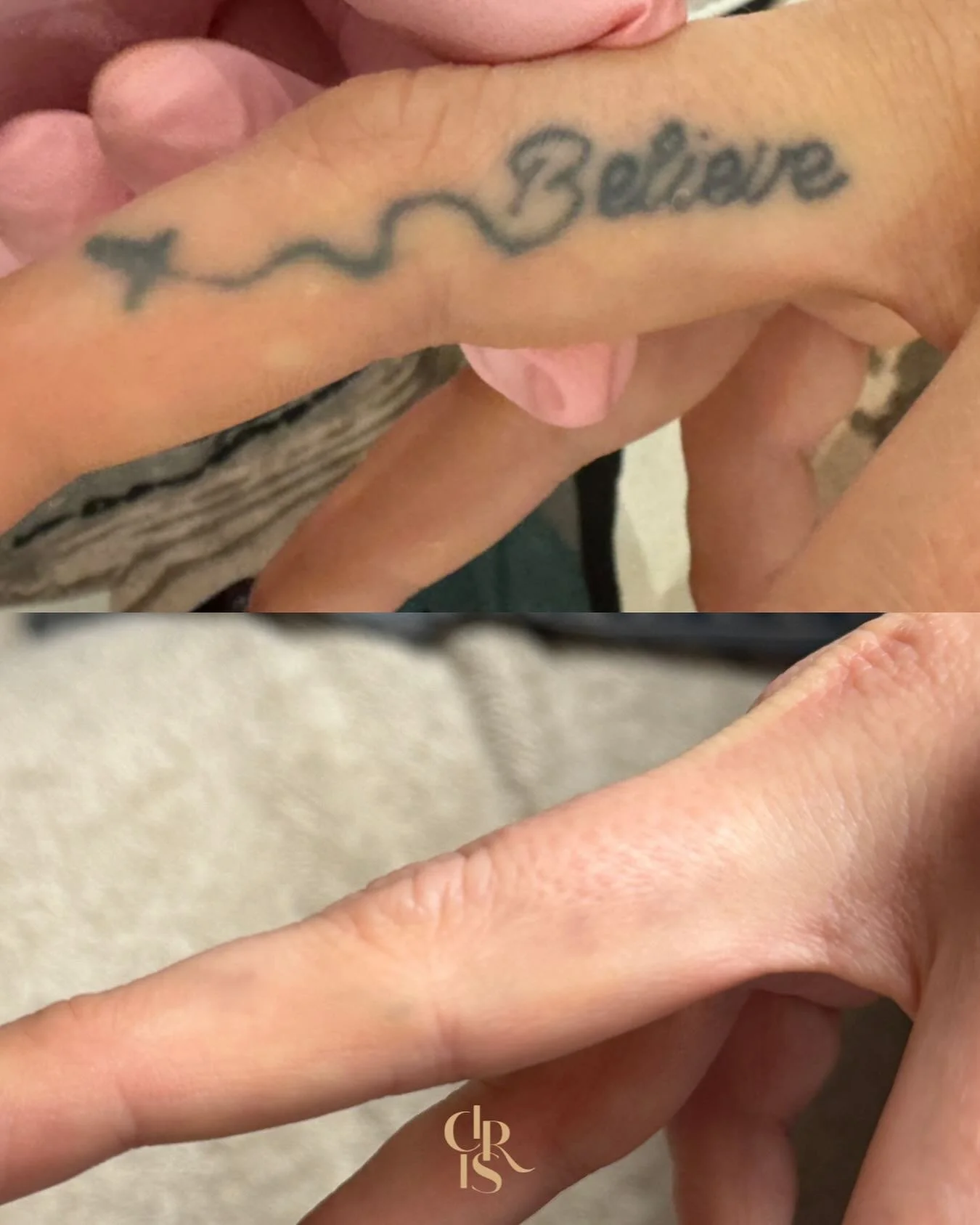 💡 Wist je dat vinger en voet tattoos het moeilijkst te verwijderen zijn?
Dunne huid, weinig doorbloeding en constante beweging maken de afvoer van inkt trager.
Met de juiste instellingen en sessies kan je wel een goede, egale fade bereiken zoals hie