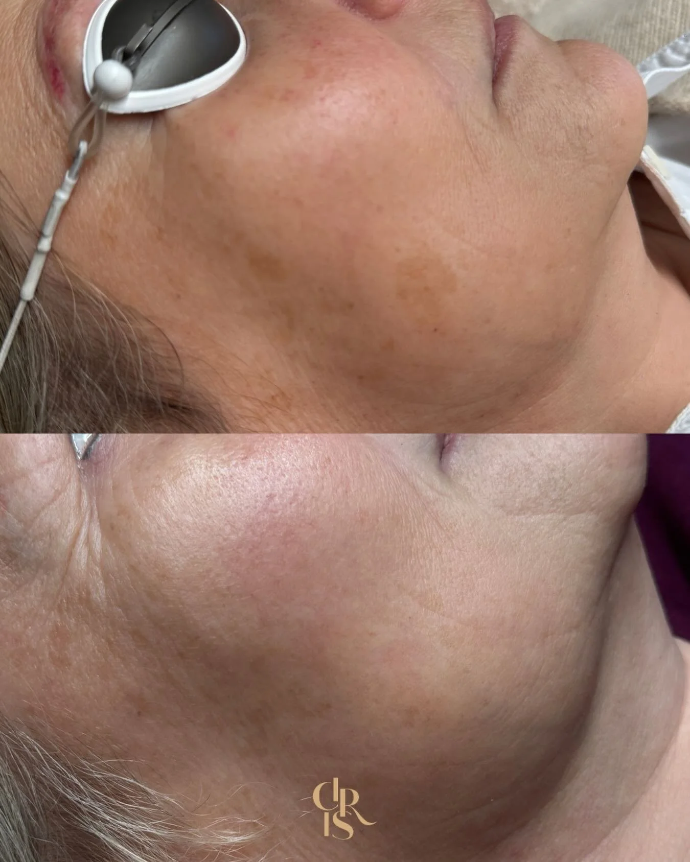 &ldquo;𝑷𝒊𝒈𝒎𝒆𝒏𝒕𝒗𝒍𝒆𝒌𝒌𝒆𝒏&rdquo;

Last van pigmentvlekken?
Onze picolaser biedt een doeltreffende oplossing, op maat van jouw huid. ✨

De picolaser fragmenteert melanine in ultrafijne deeltjes,die vervolgens door het lymfestelsel worden afg