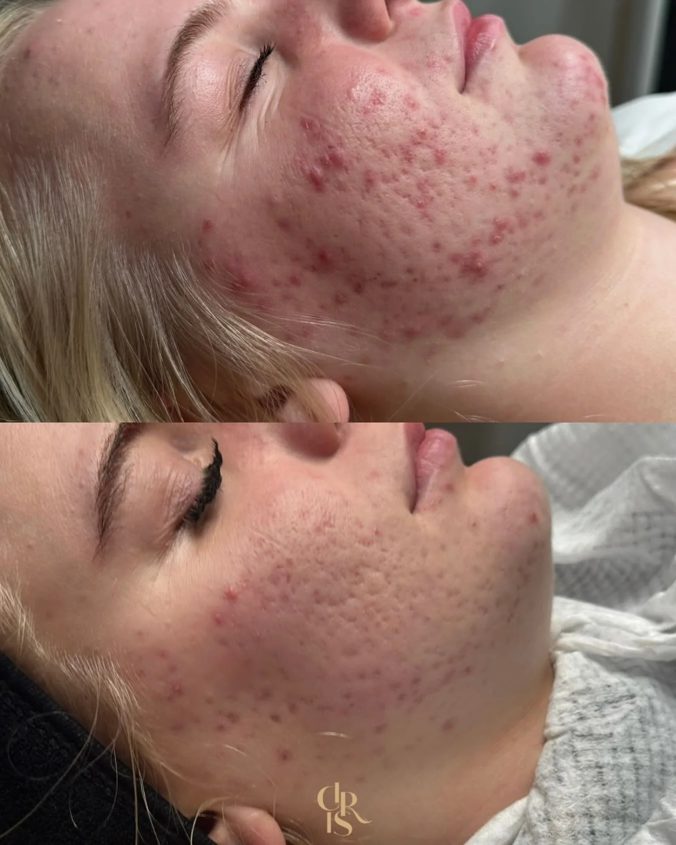 ✨ Voorlopig resultaat na 3 maanden acne behandeling ✨

Dit is wat mogelijk is met de juiste aanpak
Geen quick fix, wel echte huidverbetering:

Wat we nu al deden: 
&bull; slechts 2 grote behandelingen enkel met producten hier in het salon (nog geen g
