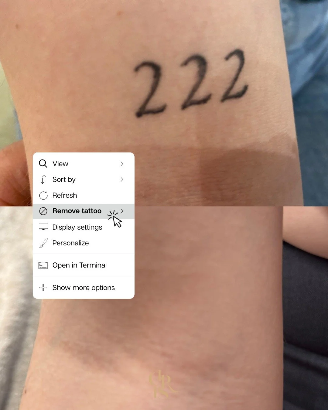 Het is alsof er nooit een tattoo is geweest. 😍

Dat is precies wat we willen bereiken met onze tattoo removal.

Voor deze tattoo hadden we in totaal 8 sessies nodig, met telkens een behandeling om de 2 tot 4 maanden. Het is dus geen quick fix. Het v