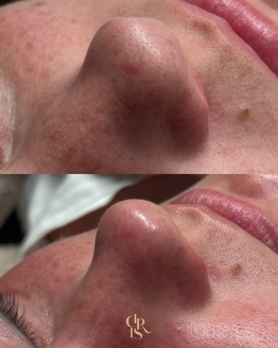 De zwarte puntjes zijn iets waar we bij elke facial op focussen.

We werken met een ultrasoon apparaat of combineren dit met de superboost om de zwarte puntjes uit de huid te verwijderen.

Na elke facial bij ons zie je direct een zichtbaar verschil. 